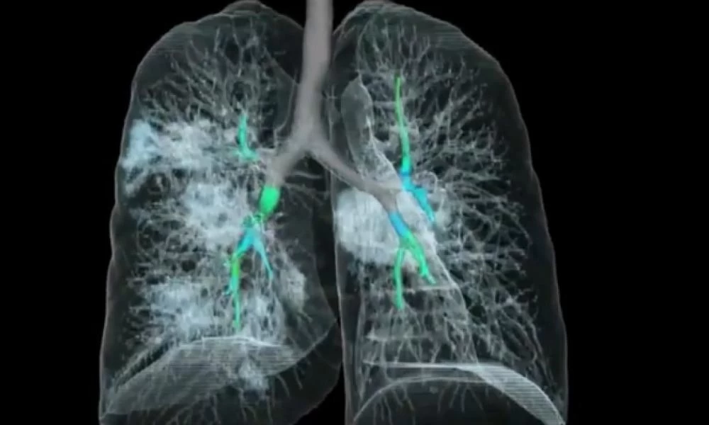 Κορονοϊός: Πώς «επιτίθεται» στον οργανισμό μας - Δείτε το βίντεο